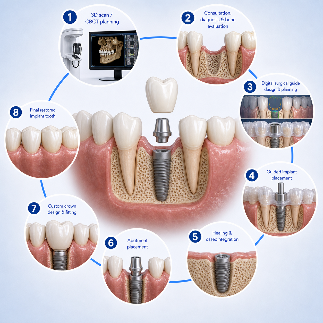 Eight illustrated stages: 3D scan and CBCT planning; Consultation, diagnosis, and bone evaluation; Digital implant planning and surgical guide design when appropriate; Implant placement using the planned approach; Healing and integration with the jawbone; Abutment placement; Custom crown design and fitting; Final restored tooth and ongoing maintenance