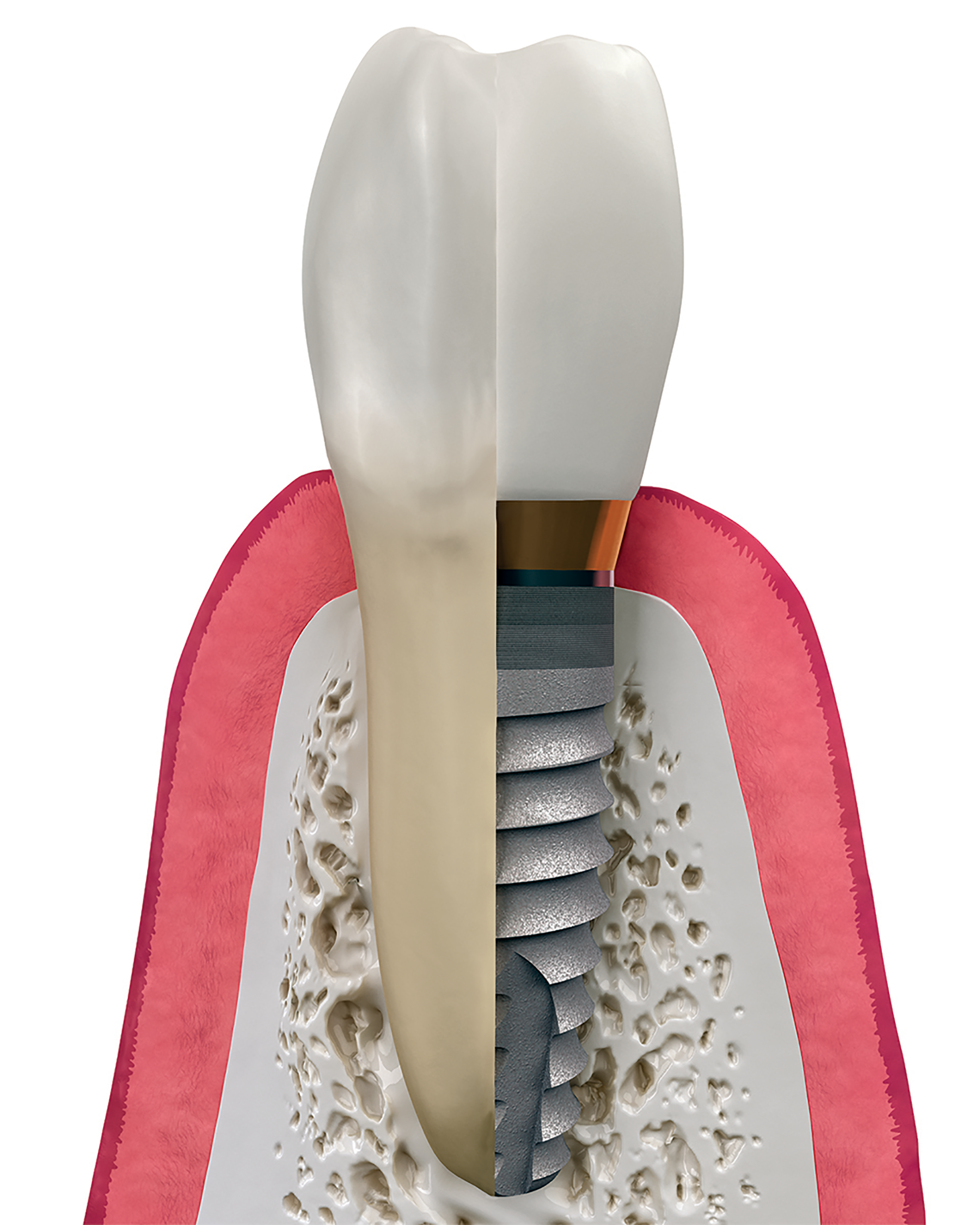 Implant Maintenance dental service visual card