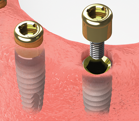 Guided Implant Surgery dental service visual card
