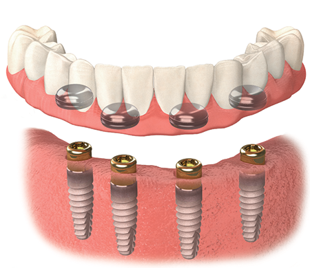 Teeth-in-a-Day dental service visual card